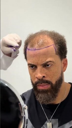 What Happens During a Hair Transplant in Turkey #hairtransplant #procedure #FUE
