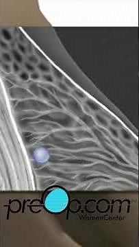 PreOp®💖: Navigating Breast Health: Wire Localization #preop #shorts #health 🔍