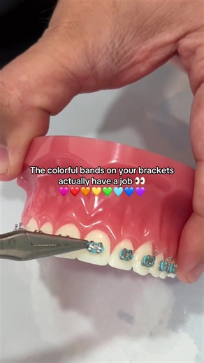 Those colors aren’t just for looks 🩷❤️🧡💛💚🩵💙💜 The tiny bands around your brackets are called elastic ligatures, and they help hold the archwire securely in the bracket so it can do its job of guiding your teeth throughout treatment. And yes, choosing a new color combo at your adjustment appointment is definitely the fun part. 😂 What color combo are you choosing at your next appointment? 👀👇 📍 Woodland Hills Orthodontics #BracesColors #Braces #BracesJourney #Orthodontics #WoodlandHillsOr