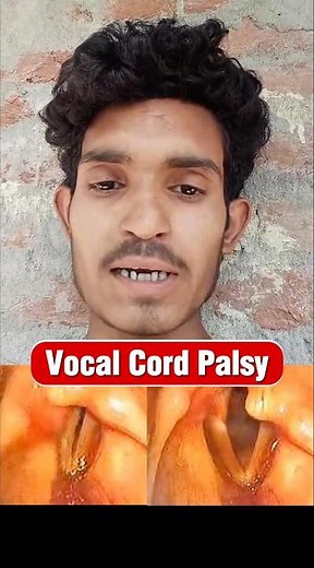Vocal Cords Paralysis | 7 Days Voice Therapy #VocalPalsy #VocalCords #Dysphonia #VoiceTreatment