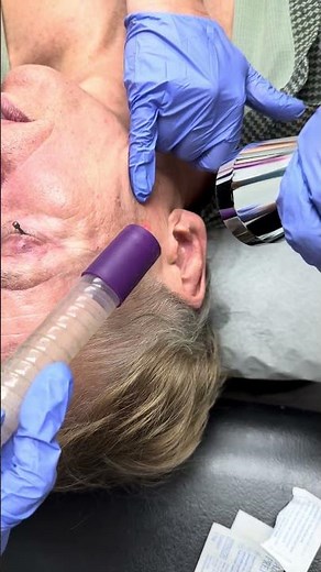 Fully Ablative Laser