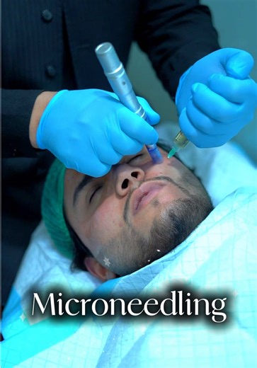 1.\t“Microneedling PRP = Glass Skin ✨” \t2.\t“PRP Facial Magic 💉✨” \t3.\t“Vampire Facial Results! 🧛‍♀️” \t4.\t“Skin Reborn with PRP 🔬” \t5.\t“Microneedling Glow Up ✨” \t6.\t“PRP Skin Transformation 🔥” \t7.\t“The Ultimate Skin Repair Facial 💆‍♀️” \t8.\t“Collagen Boost Treatment 💉” \t9.\t“Goodbye Acne Scars 👋✨” \t10.\t“PRP Microneedling Glow 💎” #laserhairremoval #fyp #foryoupage #royallasertreatmentcenter #foryou