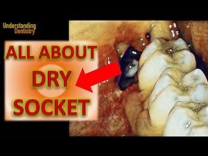 EASY Dry Socket after Tooth Extraction: ALL TIPS to prevent and Treat