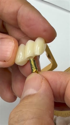 Luke Kahng on Instagram: "3-unit Zirconia Enamel bridge that we just completed in my lab for Dr. Noelle Nubani in Massachusetts"