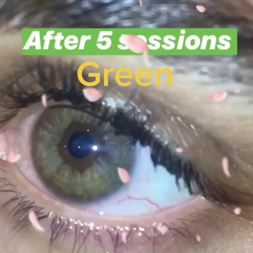 5 Intense Laser Sessions to Change Eye Color to Green