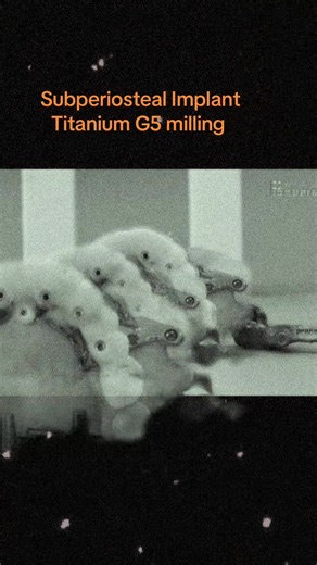 ‏Subperiosteal Implant #TITAZIRC #subperiosteal #dentista #Emax