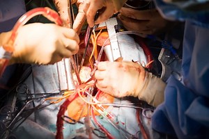 Coronary Artery Bypass Graft (CABG) - Mr Asimakopoulos