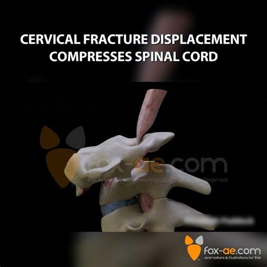 Cervical Fracture Compresses Spinal Cord