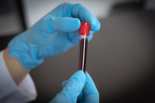 Hémoglobine glyquée : taux normal, à jeun, trop haut ?