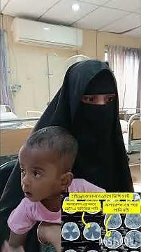 successful VP shunt surgery in Hydrocephalus treatment #hydrocephalus #hydrocephalus