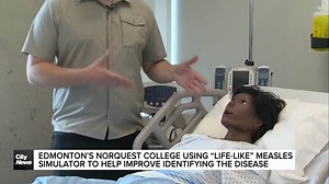 Edmonton’s Norquest College using “life-like” measles simulator to help identify the disease