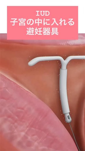 6.3M views · 447 reactions | IUD（子宮内避妊具）ってなに？...