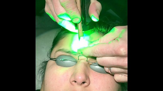 Watch Dr. Matthew Kelleher use the KTP Laser to treat an #angioma. | Premier Dermatology