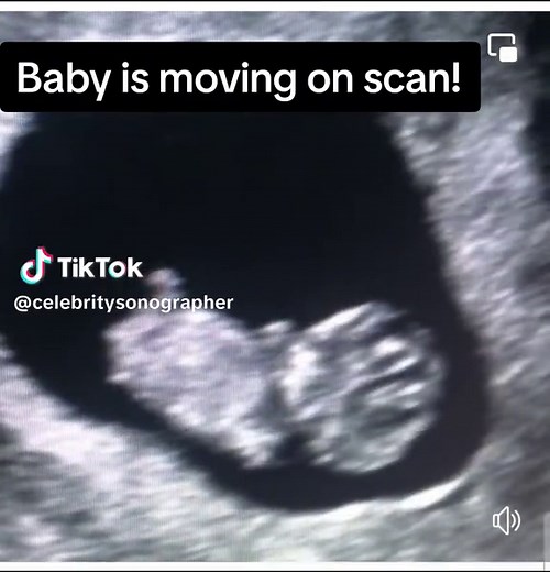 Watching Baby Move at 8 Weeks Scan