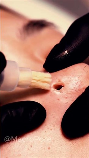 Vacuum Comedone Extraction | Dermatology Macro ASMR #4kmacro #satisfying #macroasmr