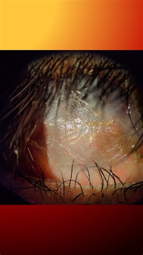 Kinshuk Mukherjee on Instagram: "*Case Spotlight 👀🔥* Stevens-Johnson Syndrome A 50-year-old female presented with severe dryness in both eyes and gradual vision loss over the past 12 years. She gave a history of drug allergy to a locally available eye ointment (likely chloramphenicol) around the time her symptoms began. No known systemic illness. No diagnosed autoimmune disease. She had previously undergone lid amniotic membrane grafting (AMG) in the left eye. Visual acuity was *HM in the righ