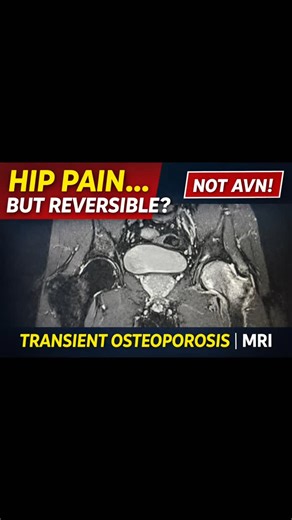 Radiology Verse on Instagram: "“MRI Hip Joint: The Painful Condition That Disappears | Transient Osteoporosis of the Hip” Persistent hip pain with normal X-rays? MRI reveals the answer. This reel highlights Transient Osteoporosis of the Hip (TOH)—a self-limiting condition characterized by bone marrow edema of the femoral head and neck, commonly seen in middle-aged men and pregnant women. 🔍 MRI Key Features: • Diffuse marrow edema (T1 hypointense, T2/STIR hyperintense) • No subchondral co