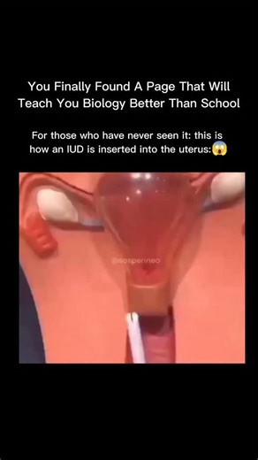 Explaining Biology on Instagram: "How an IUD is inserted into the uterus: An IUD (intrauterine device) is a small, T-shaped piece of plastic (sometimes with copper) placed by a trained healthcare provider. During the procedure, a speculum is used to see the cervix, the uterus is gently measured, and the IUD is inserted through the cervical opening into the uterus using a thin applicator. Once in place, the arms open, the applicator is removed, and the IUD sits inside the uterus to prevent pregna