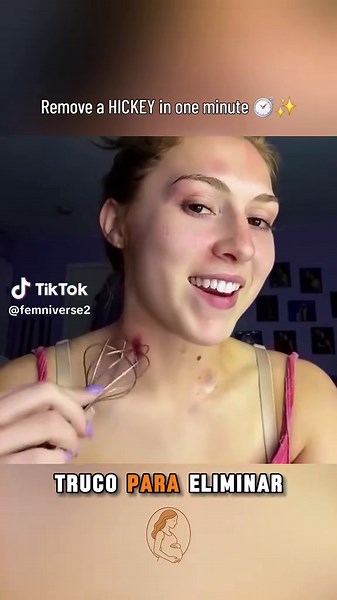 Quick 1-Minute Hickey Removal Techniques