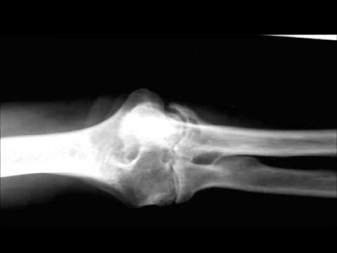 Rheumatoid Arthritis of Elbow on X ray