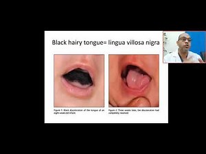 case 348 what's black hairy tongue? lingua villosa Nigra, tetracycline, melanosis, leucoplakia ,navi