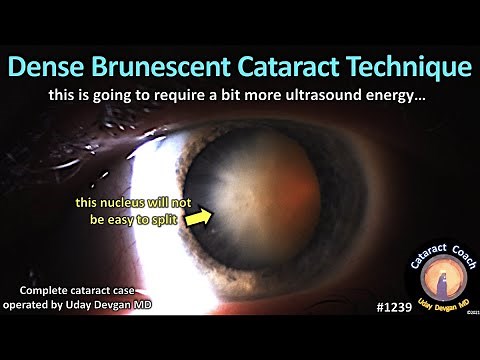 CataractCoach 1239: dense brunescent cataract technique
