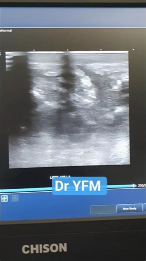 Left axillary abscess