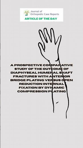 Humeral shaft fractures: bridge plating vs dynamic compression plating