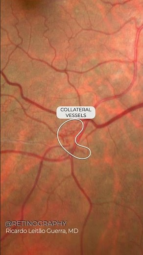 Branch retinal vein occlusion