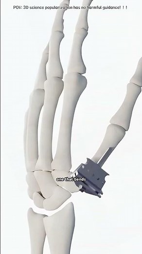 Finger Joint Replacement Surgery #pipjoint #fingerjoint #fingersurgery #fingerarthritis