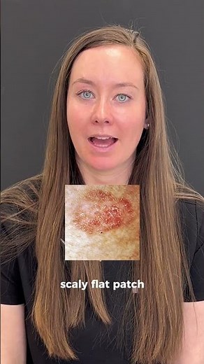 What is Squamous Cell Carcinoma (SCC)?