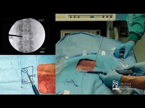 Percutaneous Screw Placement - Hyun Bae, MD