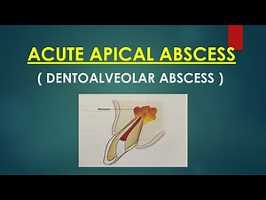 Acute Apical Abscess ( Endodontics)