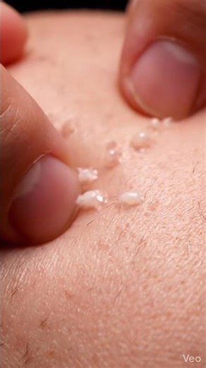 Relaxing Pimple Extraction ASMR – Clean & Satisfying Skin Care