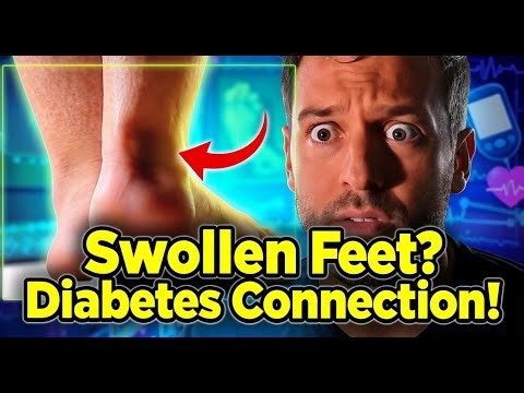 Is Swollen Feet a Sign of Diabetes? Understanding the Connection
