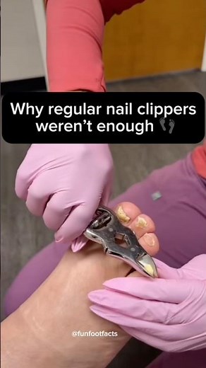 Why Regular Nail Clippers Weren’t Enough 👣 | Thick Toenail Care