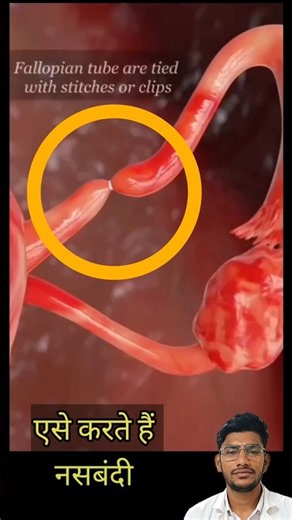 Tubectomy Procedure 😱...#tubectomy #femalesterilization#shortvideo#youtubeshorts#pregnancy#doctor#