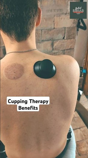 Cupping Therapy: A Simple & Effective Way to Relieve Muscle Soreness 👀👍#PainRelief #Muscle #Wellness