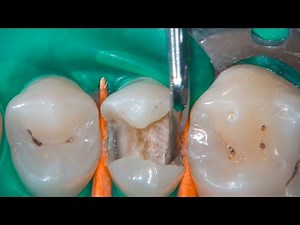 DRendo - Non-selective caries excavation: the only correct clinical approach!