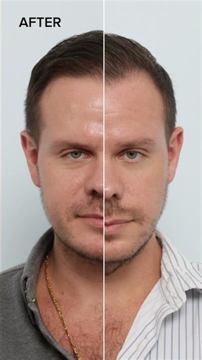 Male Jawline Contouring Transformation