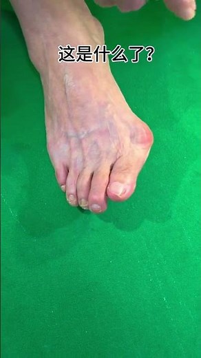 Correct Crooked Toes at Home 🏠👣 | Amazing Toe Straightening Solution 🔥