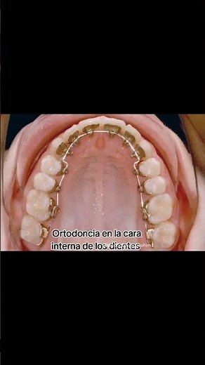 😍BENEFICIOS de la ORTODONCIA INTERNA🦷 #ortodoncia