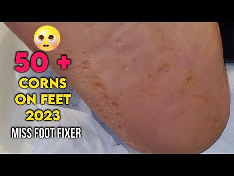 50+ Multiple Corns On Feet [ Foot Bottom Full Of Corn] Full Treatment By Podiatrist Miss Foot Fixer