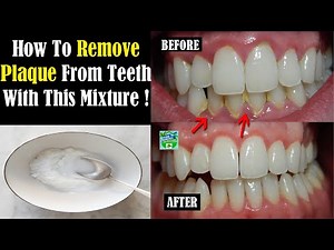 How To Remove Plaque From Teeth With This Mixture !