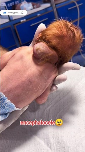 Encephalocele in a Newborn | Rare Neural Tube Defect Case Study