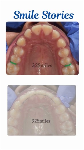 ✨ **Transforming Smiles. Building Confidence. Another beautiful orthodontic transformation by 32 sm