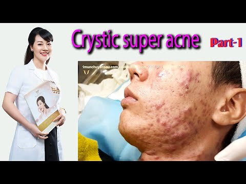 Acne treatment reputation, effective at Hien Van Spa|384I Lê Tuấn Anh-part-1