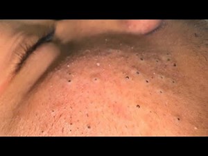 Deep Dive into Blackhead Removal — Effective Cleansing Techniques For Acne