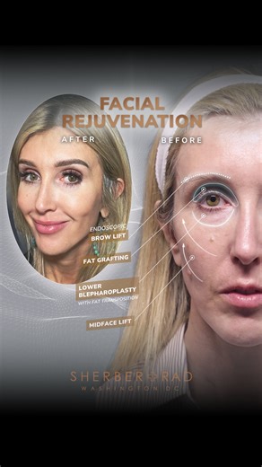 Ariel N. Rad, M.D., Ph.D., F.A.C.S. on Instagram: "My lovely patient traveled from the west coast wanting a natural refresh. As a new mom she felt that all the hormonal shifts accelerated a sequence of aging changes that I treat very commonly: drooping outer brows, deeply hollow eye sockets, under-eye bags with crepey skin, and a sagging jawline and neck. I planned her rejuvenation surgery was carefully tailored and included an endoscopic brow lift, microfat grafting, deep plane face and neck li