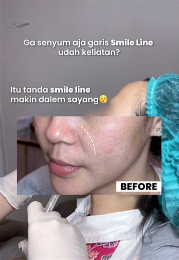 Banyak senyum emang keliatan ramah, tapi kalau punya smile line dan banyak senyum yang ada make up ngecrack semua!! Cuss segera hempaskan🥰